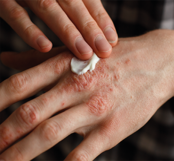 Man applying cream to hand eczema
